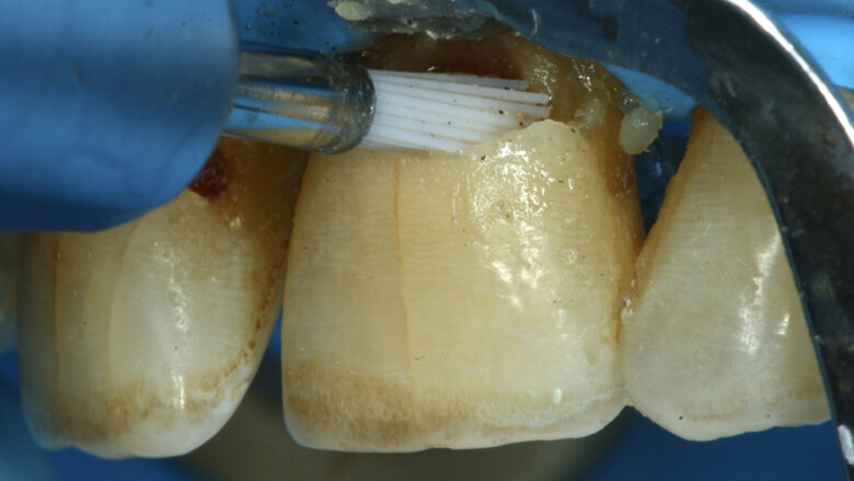 Figura 10. Se lava la cavidad con un micro-cepillo con piedra pómez y clorhexidina 0,12%.
