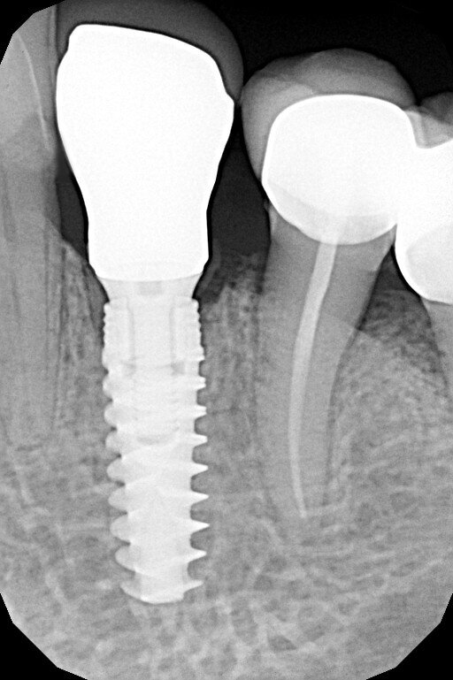 Fig. 20_Rx finale alla consegna della corona definitiva.