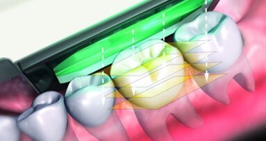 Intraorale Abformung mit der Kamera