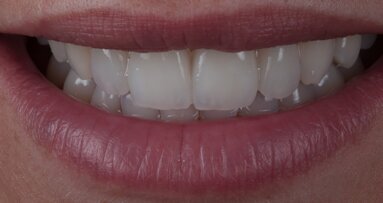 Surface texture: Using horizontal and vertical lines to simulate natural tooth appearance—Theory and technical procedure of lines