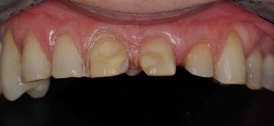 Fig. 6: Preparation, vestibular view