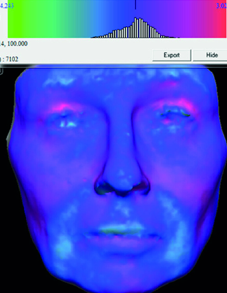 Fig. 5 : La superposition de l’image rouge du visage après le traitement et de l’image bleue du visage avant le traitement nous permet d’illustrer graphiquement le changement volumique survenu durant notre traitement. On observe une augmentation volumique dans les régions frontales, supraorbitaires, infraorbitaires, zygomatiques, de la base du nez, de la lèvre supérieure, du sillon nasogénien, des commissures labiales et des bajoues.