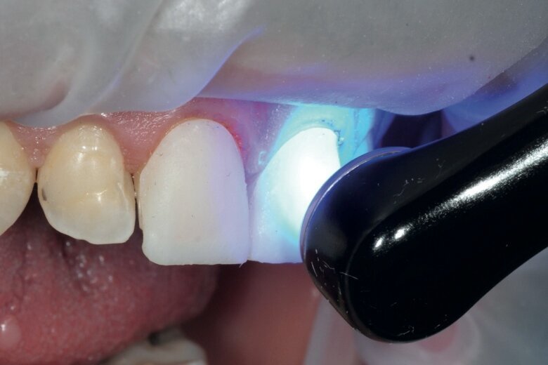 Fig. 9 Light-activated polymerisation of the entire surface of the temporary veneers.