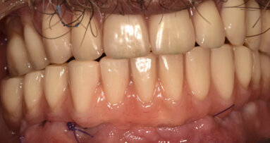 De nouveaux matériaux pour la prothèse sur implants