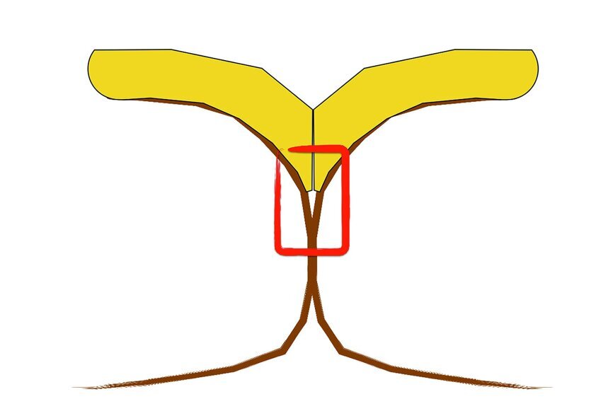Fig. 2: When the teeth have apparent curvature, no-preparation veneer may have weak contact area. Micropreparation veneer is more appropriate.