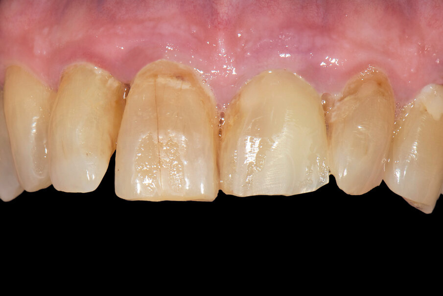 Fig. 1: Initial situation: Composite structure at 21 after distal transverse fracture of the tooth crown. 