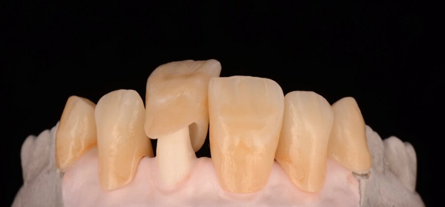 Fig. 24: Fitting the GC Initial LiSi Press restoration on to the zirconia framework.