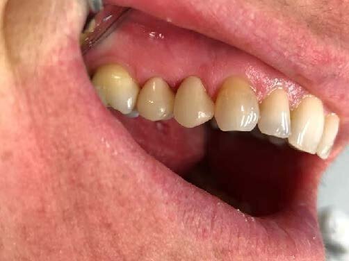 Fig. 7: Final result from side