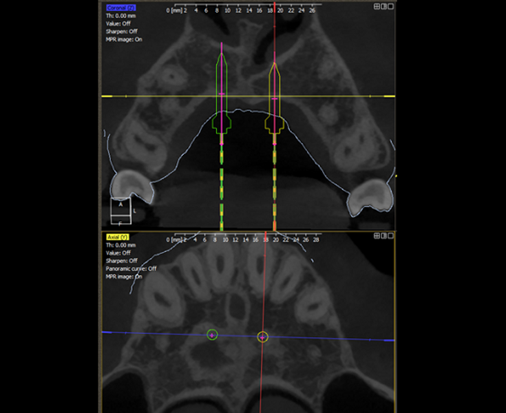 Fig. 1: Digital planning of optimal implant placement using DDS-Pro software. 