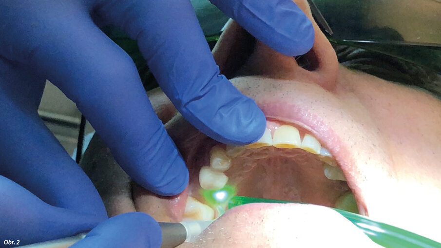 „Incize“ laloku pomocí laserové hlavice LightWalker Nd:YAG (vlákno o průměru 200 μm, 3 W, 70 Hz, MSP).