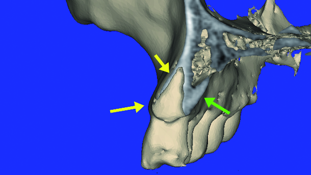 Improved CBCT diagnostic acuity with the ‘Lip-Lift’ technique