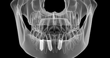 Estudo encontra desvio entre posições de implante reais e planejadas