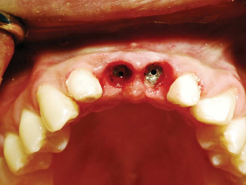 Fig. 8: Picasso Lite+ diode laser removing soft tissue to uncover the implants’ cover screws. (Photo provided by Dr. Gregori M. Kurtzman)