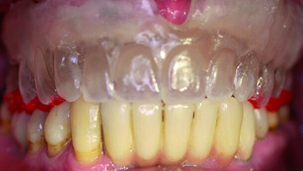 Empreinte et enregistrement pour prothèses complètes amovibles supra-implantaires