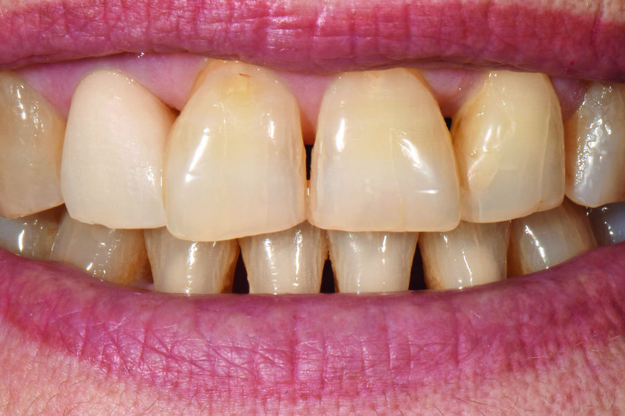 Fig. 3: The raw firing try-in after the first dentin firing still shows a crown that is much too bright.