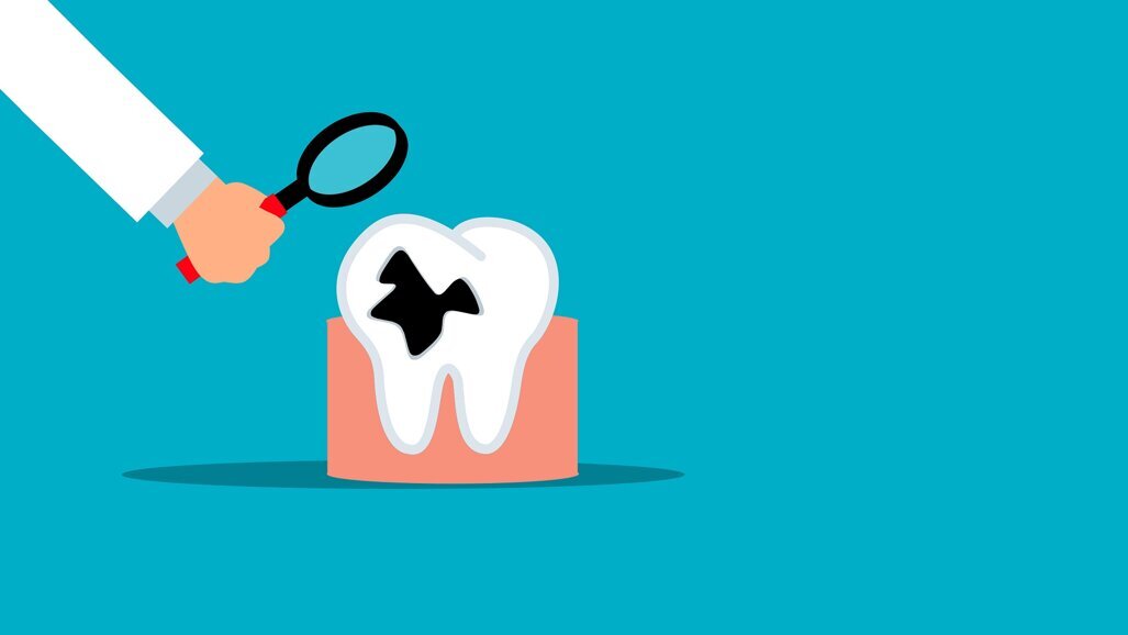 Extreme Materials apresenta coroas pediátricas para tratamento de cáries