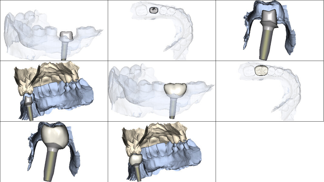  Fig. 9: Design of Atlantis abutment and provisional crown.
