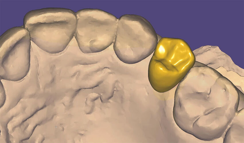 Fig. 5_La proposta protesica digital wax-up.