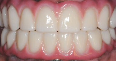 Edentulous arch restored with BruxZir Full-Arch Implant Prosthesis