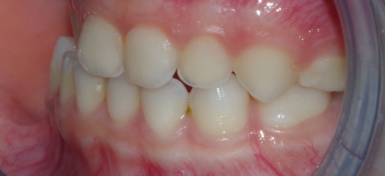 Fig. 13c: Initial intra-oral photograph: left lateral view.