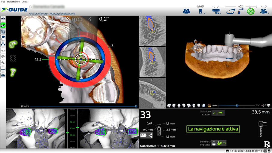 Fig. 8_Screenshot del posizionamento implantare in chirurgica navigata; il margine finale di deviazione risulta pari a 0,2 mm.