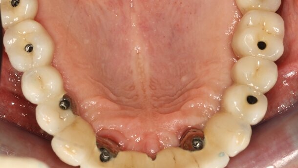 Guides chirurgicaux en implantologie : indications et limites