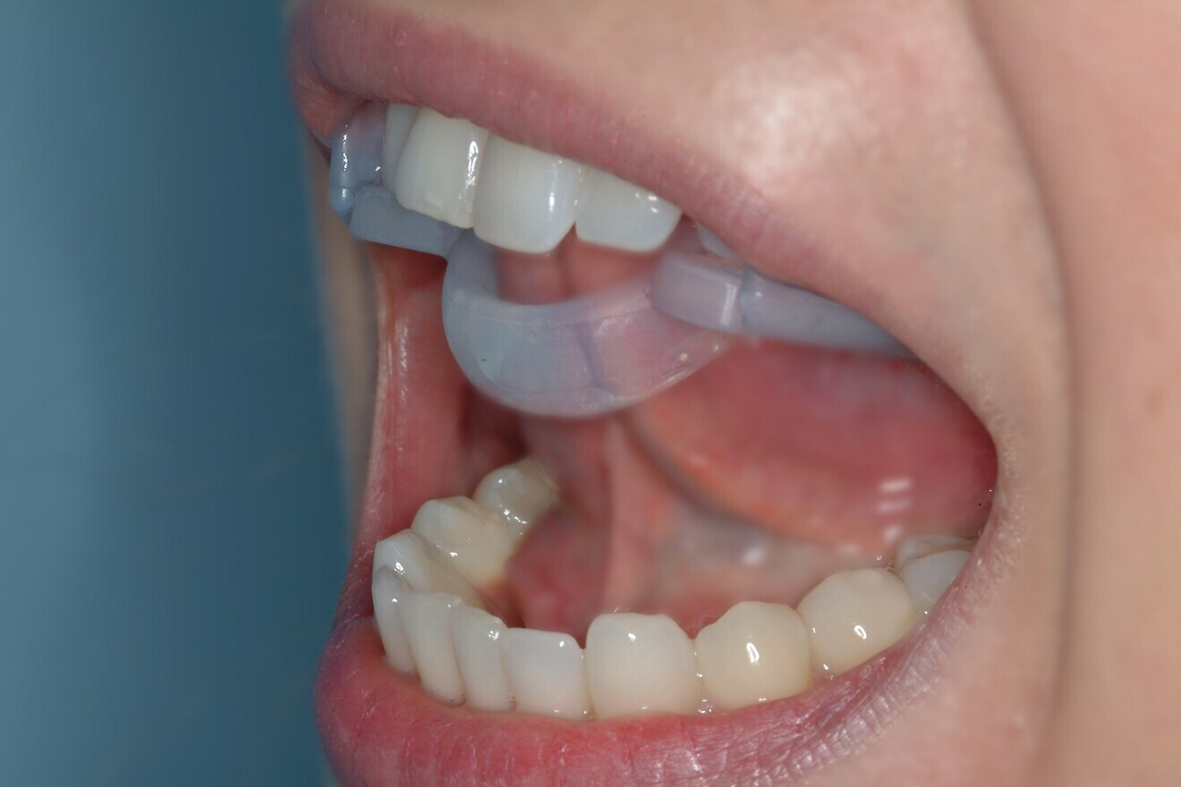 Fig. 9: Ri.P.A.Ra. lingual ring.