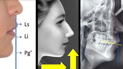 El control vertical del sector posterior mandibular