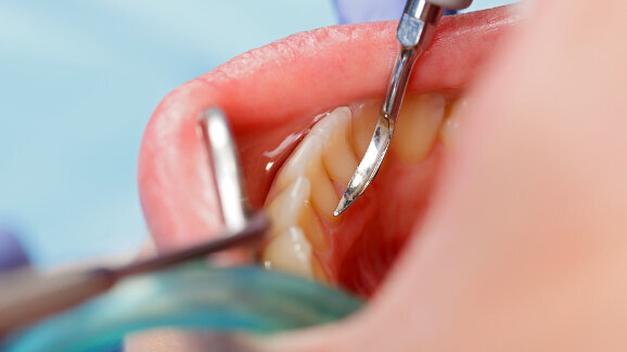 El curetaje dental reduce el riesgo de infección tras el reemplazo de rodilla