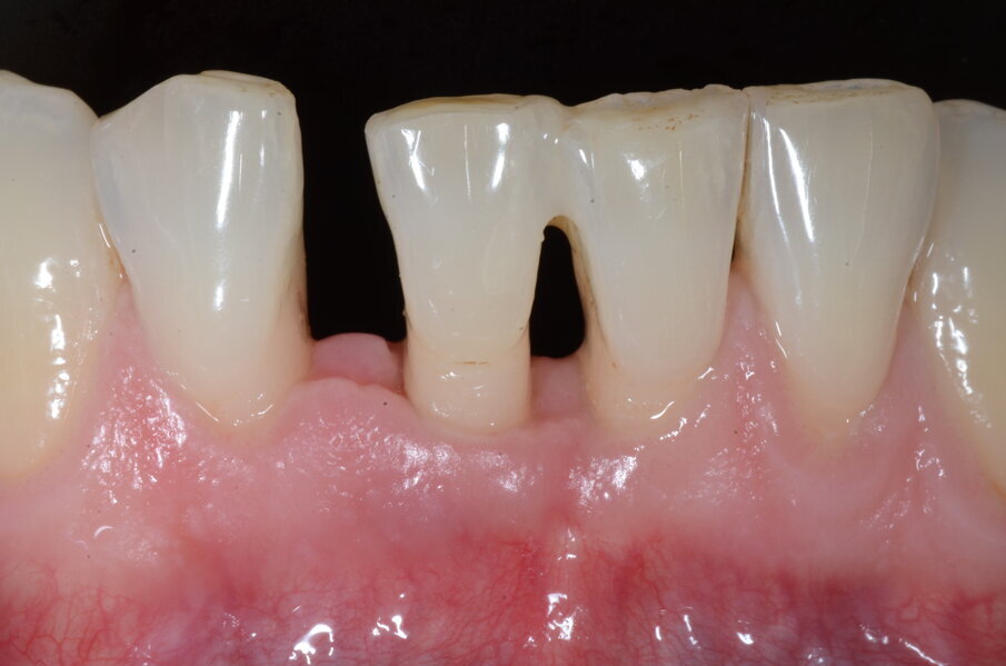 Figg. 6h-6j - Guarigione ad 1 settimana.