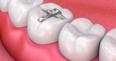 Preocupación por la eliminación prematura de la amalgama dental