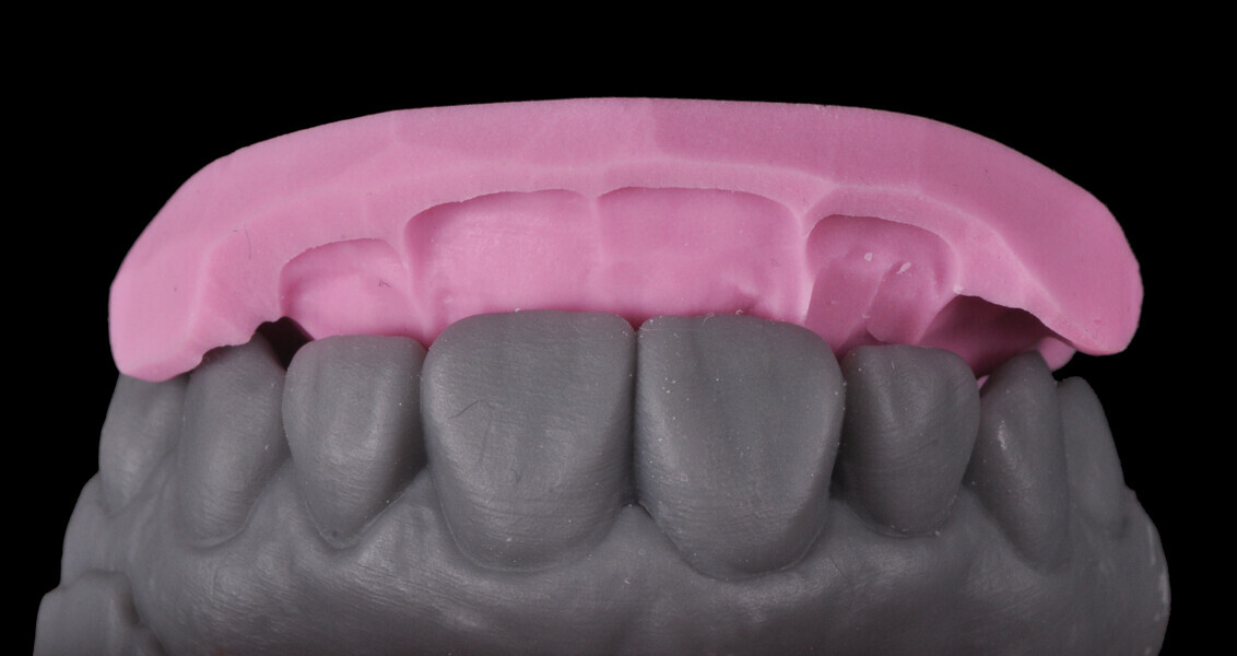 Fig. 5: Palatal silicone index produced for the conventional direct restoration steps.