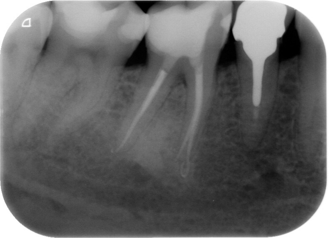 Fig. 20 : Radiographie de suivi à douze mois montrant la cicatrisation complète de la lésion périapicale.