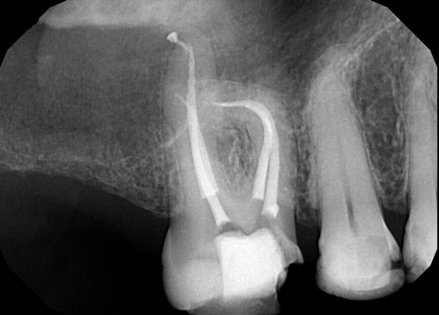 Fig. 18c: Note the expert management of the apical constriction and the acute curvature of the MB root (courtesy of Dr. Nestor Cohenca).