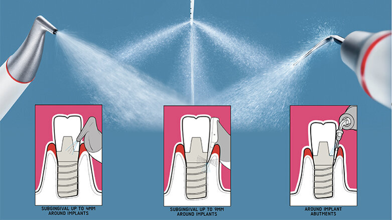 Implant Maintenance with Guided Biofilm Therapy
