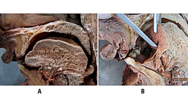 Anquiloglosia-Frenillo lingual-Frenotomía. (Parte I) Diagnóstico
