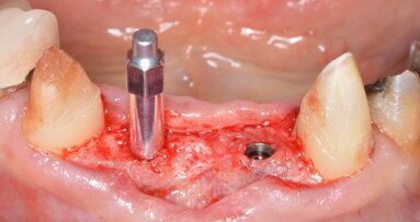 Three questions on insertion torque value and implant stability quotient