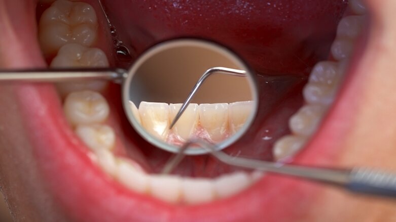 FGDP(UK) leads campaign encouraging screening for erosive tooth wear