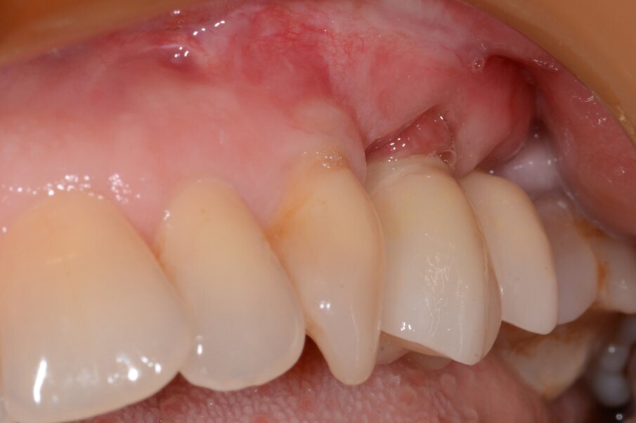 Fig. 12: Final results with restoration two years post-op.