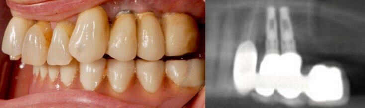 Fig. 1 - Aspetto clinico e radiografico della paziente alla presentazione. Gli impianti in posizione 2.4 e 2.5 presentano un sondaggio > 5 mm; si noti come in corrispondenza dei due impianti ci fosse gemizio purulento peri-implantare spontaneo.