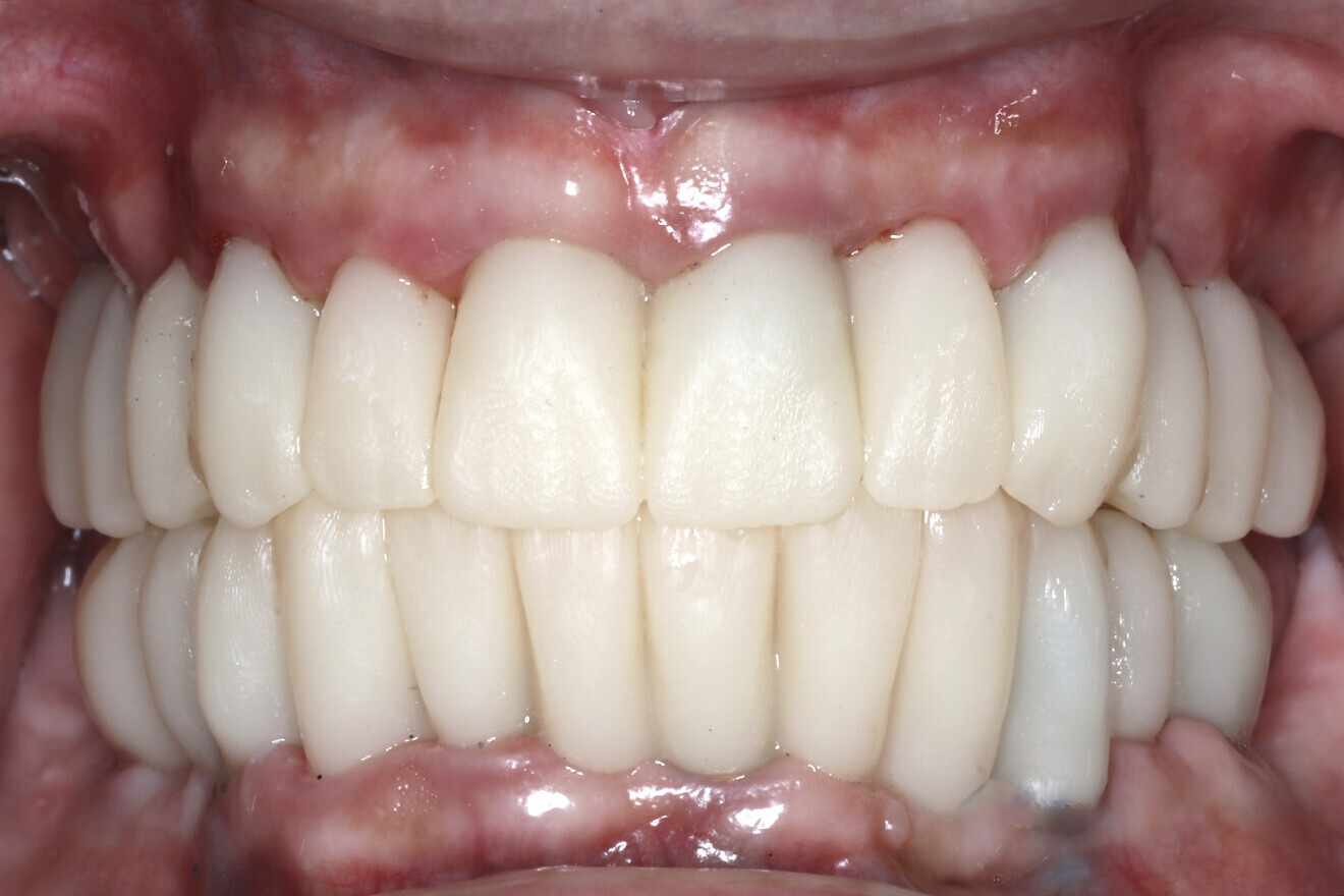 Fig. 12b: Using extracted teeth to achieve autologous bone substitute using the Smart Dentin Grinder.