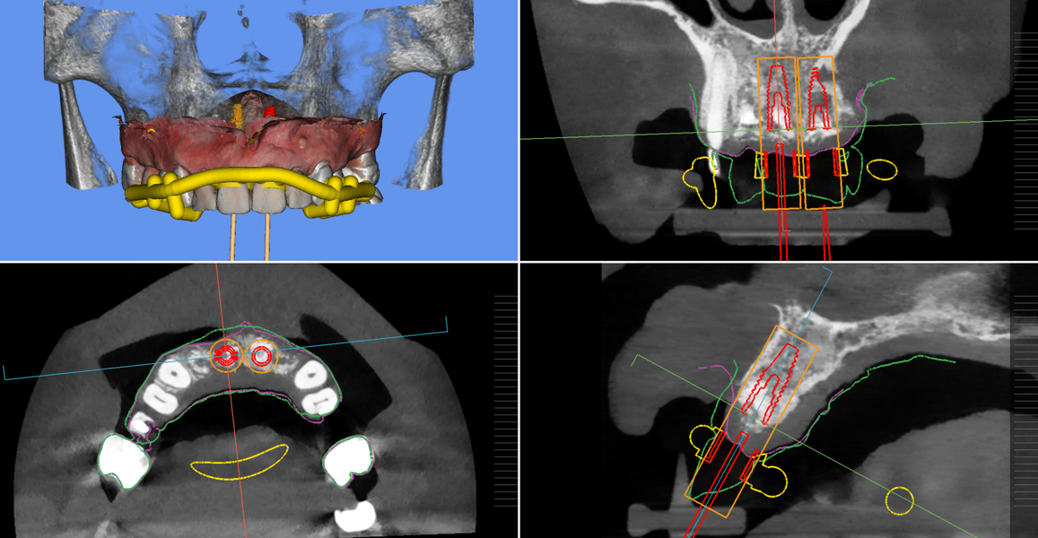 Figs. 11a–c: Implant planning and guided surgical guide design.