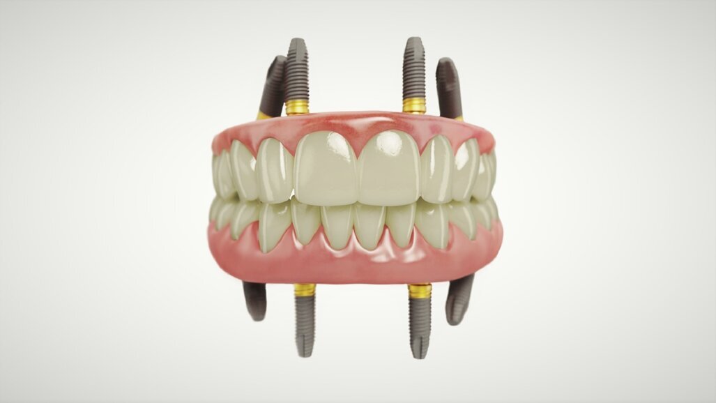 New study findings on Xeal and TiUltra surfaces with All-on-4 treatment concept