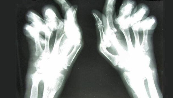 RZS wpływa na stan zdrowia dziąseł