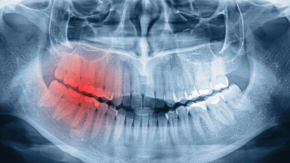 MKG-Chirurgie zwischen Implantologie und Tumorchirurgie