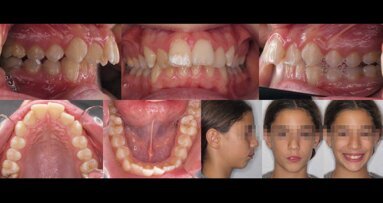 Trattamento di una seconda classe scheletrica con l’uso di resine fotopolimerizzabili