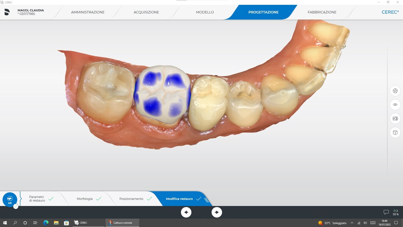Fig. 5b: Preview of the endocrown design.