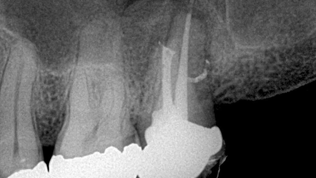 Efekat primene parcijalnog vakuuma na hemijsku obradu sistema kanala korena: Sleimanova faza