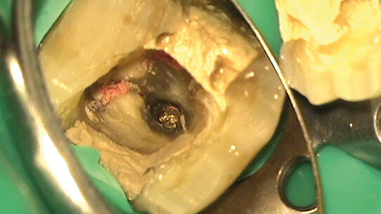 Ritrattamento di un molare inferiore