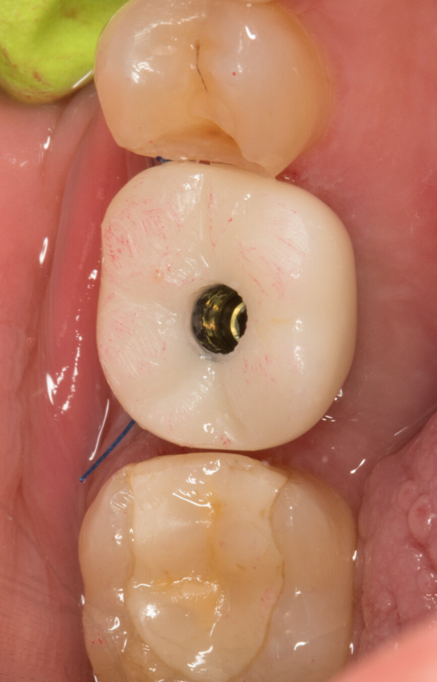 Ryc. 26-28_Osadzona korona tymczasowa przykręcana.

